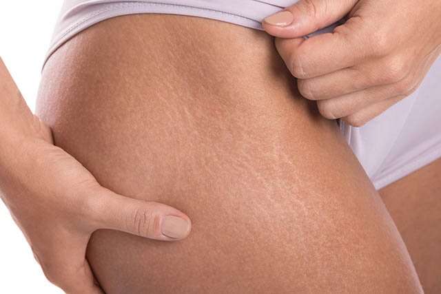 Rid Stretch Marks